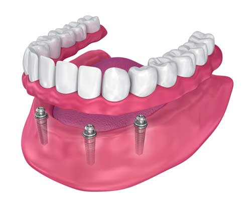 Dental Implants - All on 4