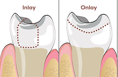 Inlay and Onlay Comparison inlay and onlay illustration comparison
