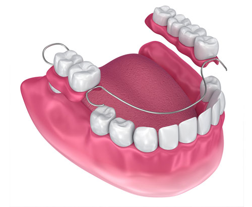 Partial Denture