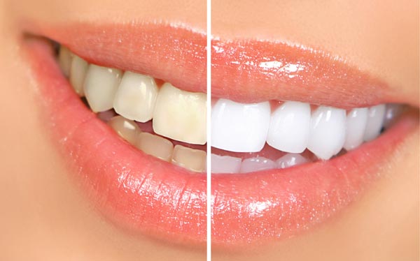 Teeth Whitening Before & After