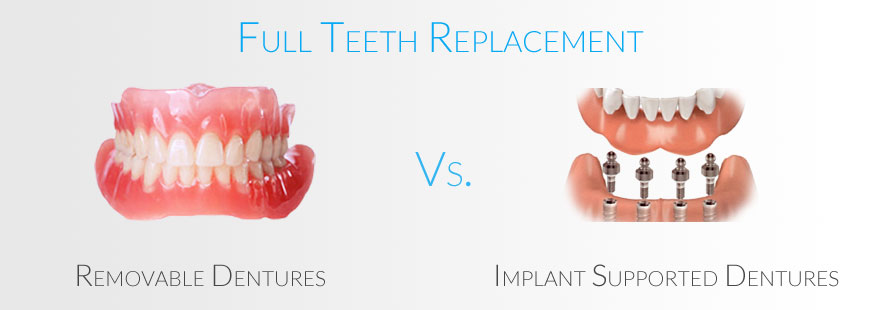 Removable Vs. Implant Supported Dentures