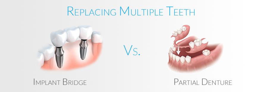 Partial Denture Vs. Implant Supported Bridge Partial Denture Vs. Implant Supported Bridge