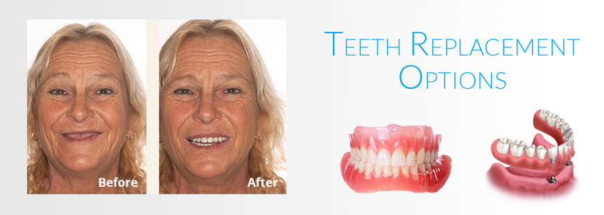 Teeth Replacement Options