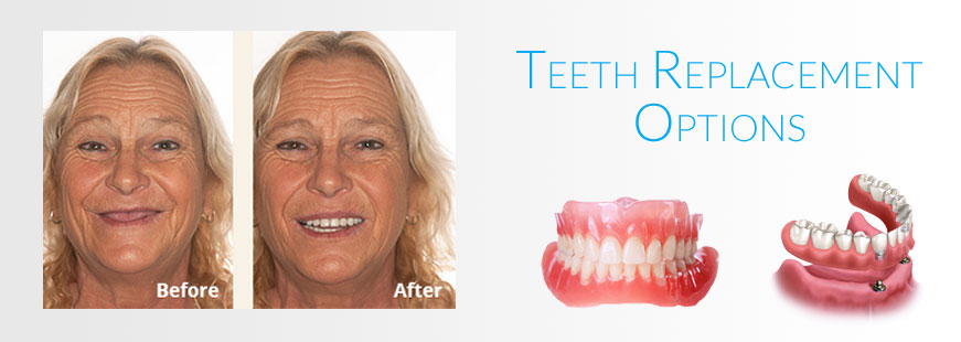 Teeth Replacement Options Teeth Replacement Options