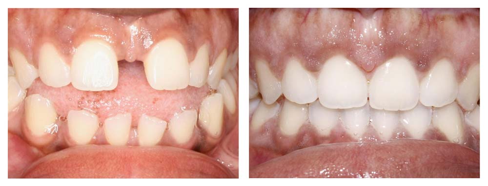 Before & After Invisalign Results