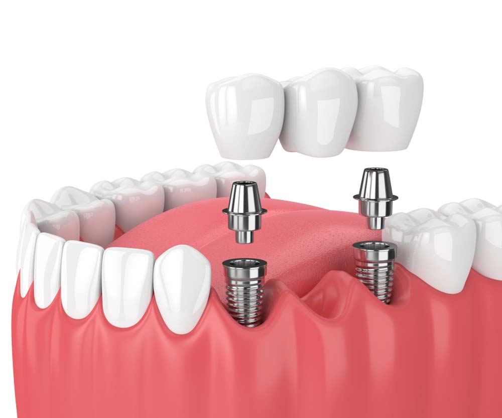 Dental Bridge Illustration