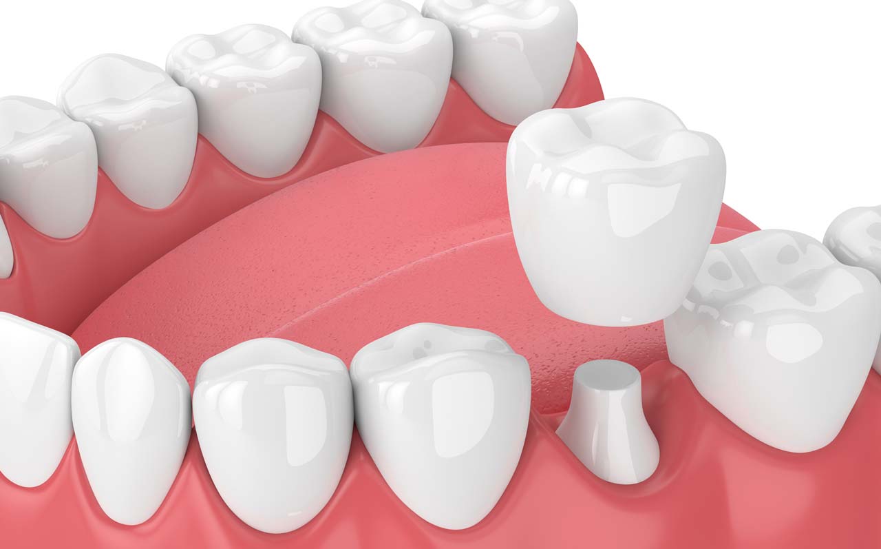 Dental Crown Illustration