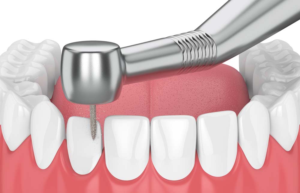 Dental Veneer Procedure Illustration