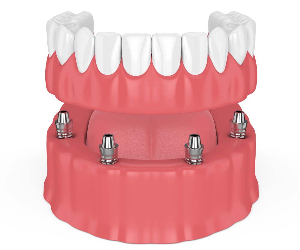 Full Mouth Implant Dentures Illustration