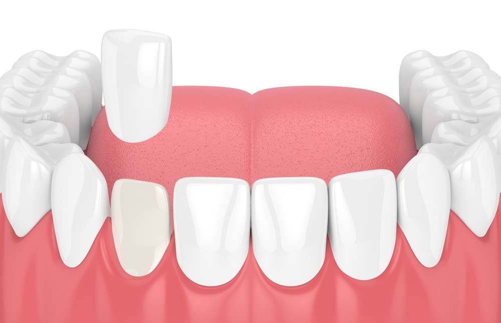 Porcelain Veneers Illustration