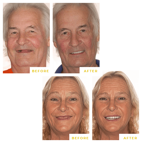 Real Patients Before & After Dental Implants