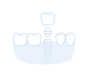 Dental Implants Illustration