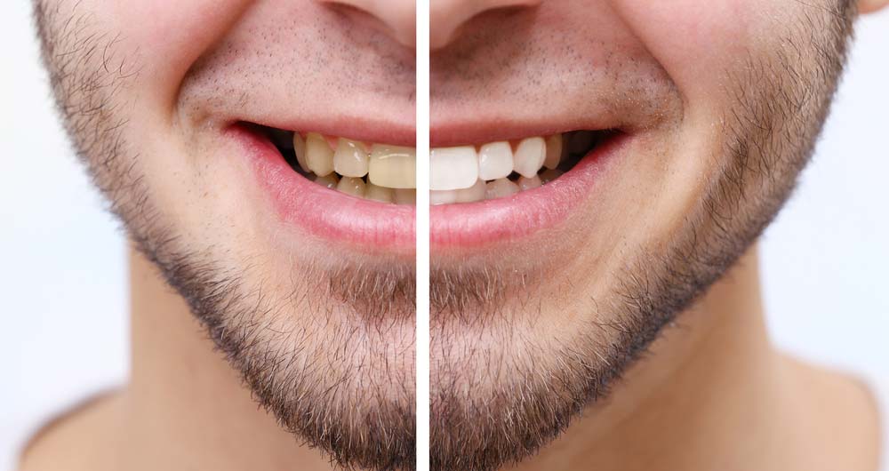 Teeth Whitening Before & After Patient