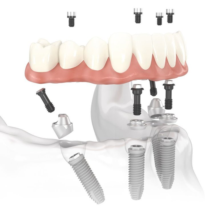 Full Mouth Dental Implants Illustration