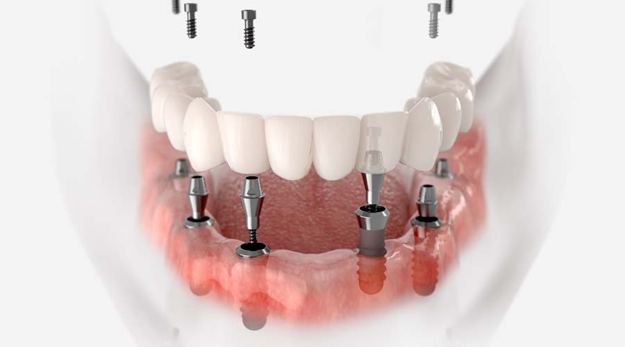 Denture Retained by 4-6 Dental Implants