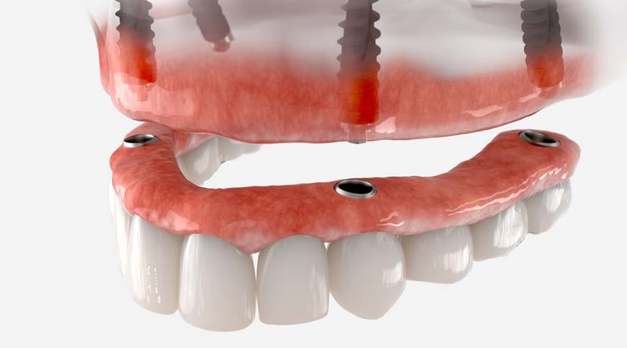 Snap on Denture via All-on-4 Dental Implants