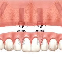 Secure Dentures
