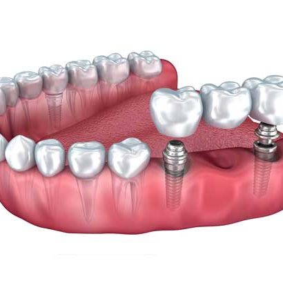 Implant Supported Bridge