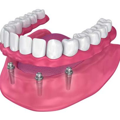 Dental Implants - All on 4
