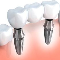 Implant Supported Bridge