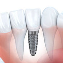 Single Tooth Replacement